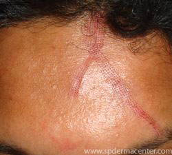 Acne Scar Co2 Fraxel